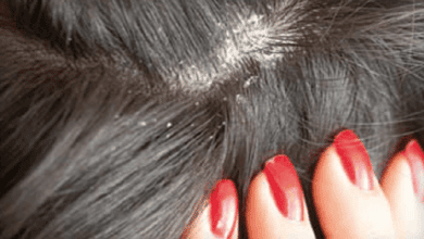 أسباب ظهور قشرة الشعر وطريقة علاجها