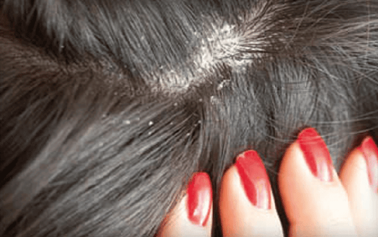 أسباب ظهور قشرة الشعر وطريقة علاجها